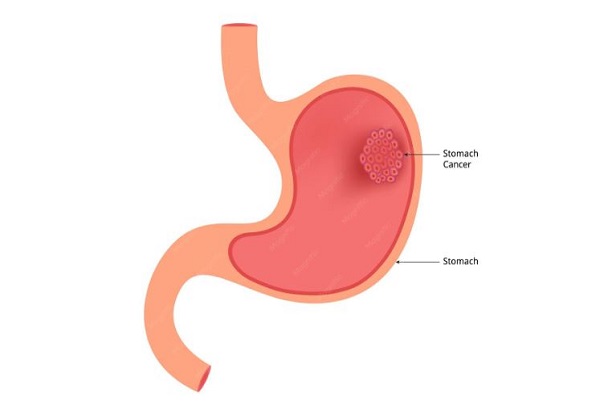 Detection of DNA biomarkers circulating in blood for gastric cancer detection using indigenously developed P-Fab platform